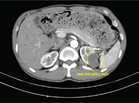 Đau tức mạn sườn, tiểu ra máu không ngờ bị u thận